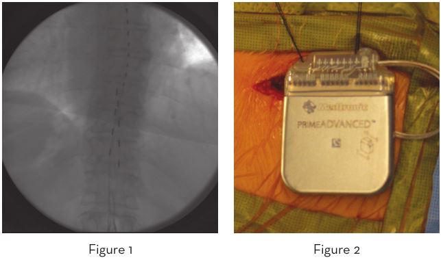 Ischemic Limb Pain and Chronic Abdominal Pain Treated with Spinal Cord Stimulation A Case Report.JPG